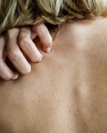 Zakaj imamo pogostejše kožne alergije v menopavzi in kako jih omiliti?