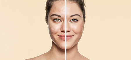 v_before_after-acne.jpg
