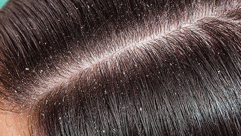 HUB_CONTENT_DHSC_CONTENT_23_FROM_A_HEALTHY_SCALP_TO_A_DANDRUFF_CONDITION.jpg